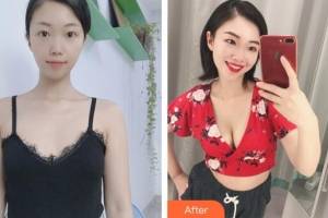 徐州美莱整形医院崔海燕整形价格表附自体脂肪丰胸案例展示