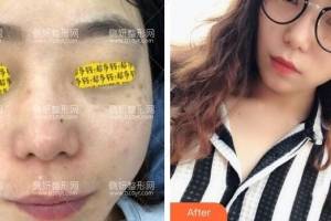 深圳阳光整形美容医院陈瑞红皮肤美容怎么样附最新价格表