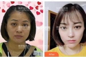 长沙美之峰医疗美容门诊部解灿眼综合怎么样附最新价格表