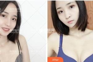 长沙雅美整形医院肖征刚隆胸手术怎么样附最新价格表