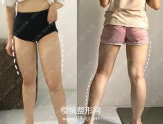 重庆美莱吴继东大腿吸脂