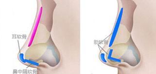 肋软骨隆鼻多少钱_肋软骨隆鼻整形手术价格