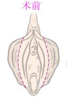 阴道紧缩手术