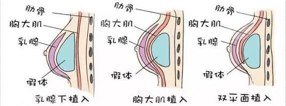 假体隆胸手术