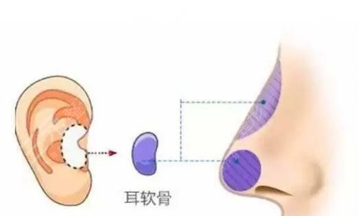 耳软骨鼻子效果