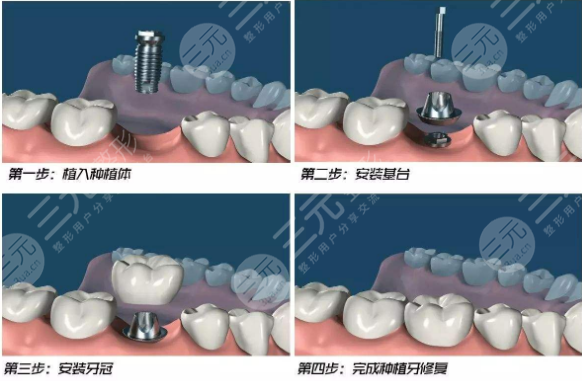 国产种植牙多少钱