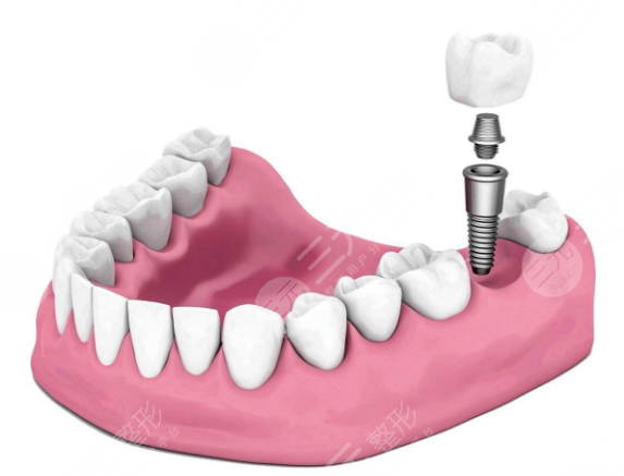 国产种植牙多少钱