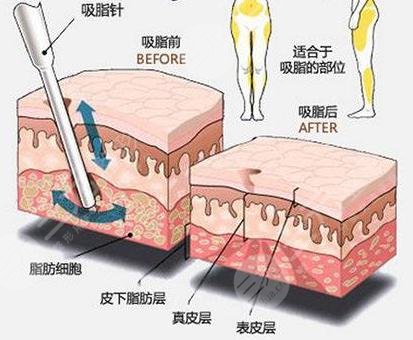 钻石精雕吸脂价格