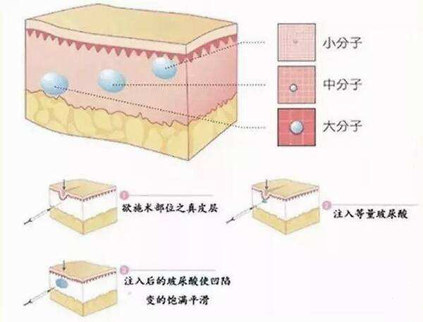 上海古北悦丽医疗美容科普玻尿酸填充