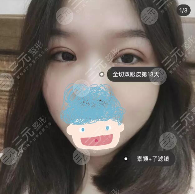 八大处美容整形王淑杰双眼皮案例：术后一周