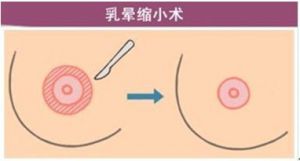 乳晕缩小整形术