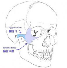 颧骨内推手术