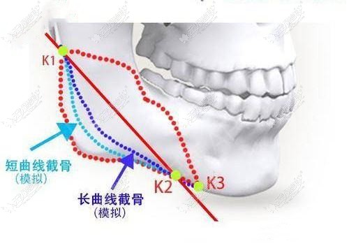 赵贵庆下颌角截骨技术