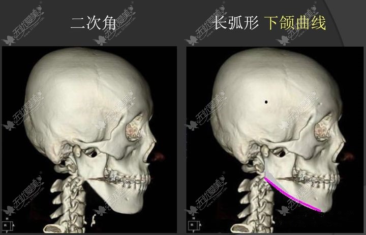 赵贵庆磨骨实例