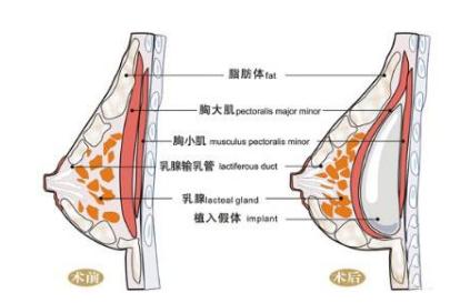 假体隆胸10个人有9个做完后悔？后遗症这么恐怖吗？