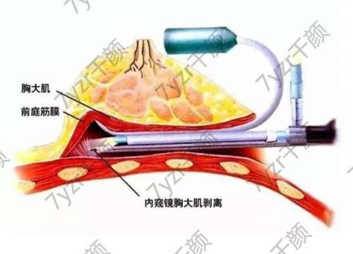 春季隆胸是好时候吗?打造自然胸部夏季更好看~!