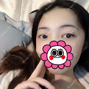 在重庆美圣美邦做双眼皮修复1个月