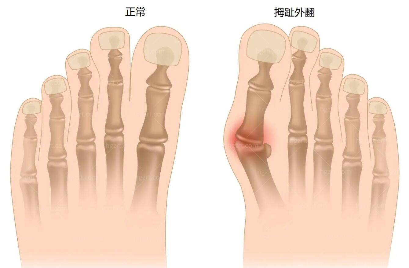 深圳拇外翻整形好医院排名