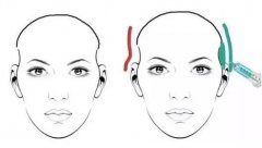 填充太阳穴需要用多少玻尿酸？效果怎么样？