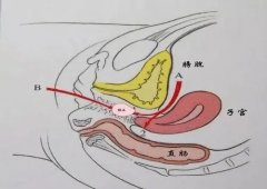 郑州治疗阴道闭锁，阴道闭锁是怎么回事？症状？会