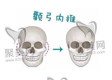 颧骨内推加下颌角一共多少钱？