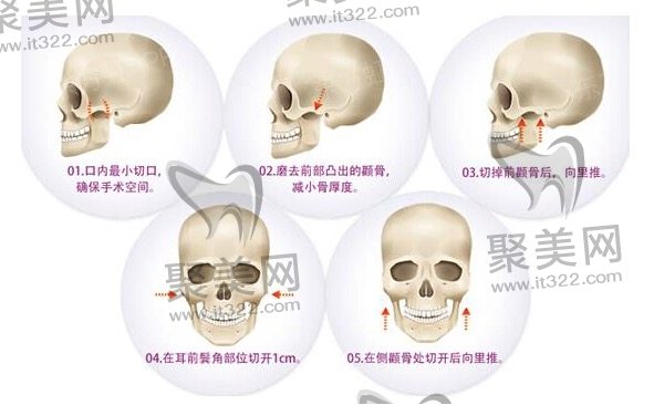 颧骨内推加下颌角手术过程