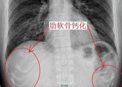 用于隆鼻的硅胶钙化是什么意思?假体需要切除吗？