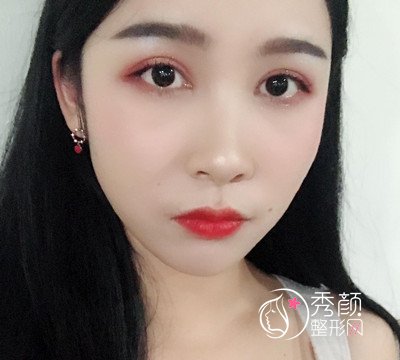 上海华美杨亚益割双眼皮开眼角恢复过程，7mm扇形真的很适合我！