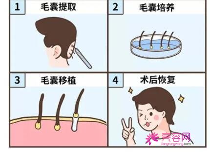 广州市红十字会医院整形科植发价格，内附科室资料和植发真人案例