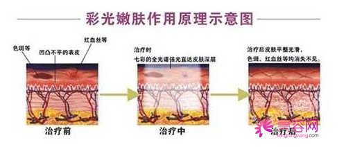 做彩光嫩肤好不好？这项技术可以治疗什么？做彩光嫩肤的注意事项