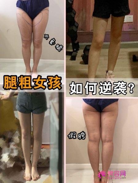 毕洪森吸脂技术怎么样？内附手术恢复真实果图