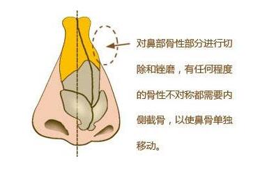 厦门修志夫整形医院歪鼻整形的效果自然吗 有没有危害呢