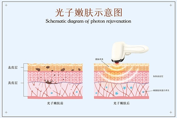 摄图网_401866749_banner_光子嫩肤医美配图（非企业商用）.jpg