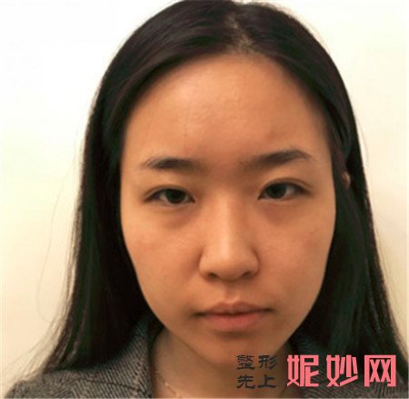 来看看北京黛美医疗美容诊所弯鹏飞自体脂肪面部填充的真人案例对比图分享！