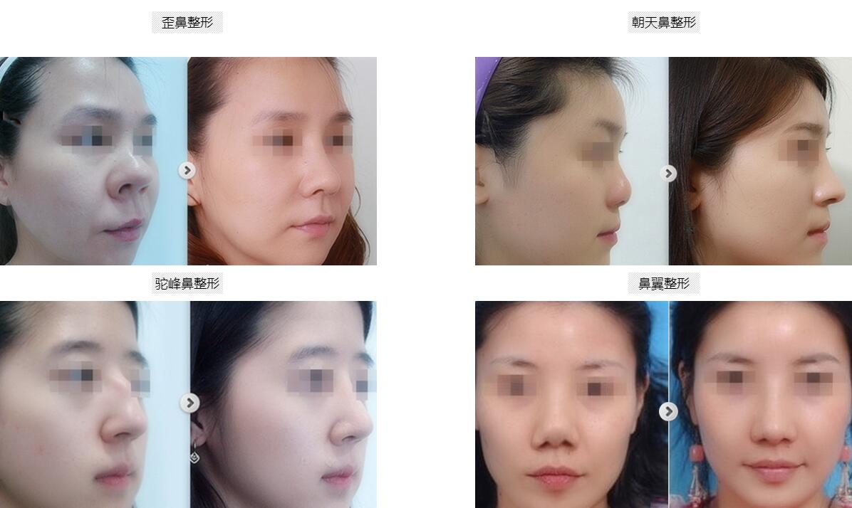 南宁慧美鼻整形专家全方位技术剖析_如何拥有精致美鼻