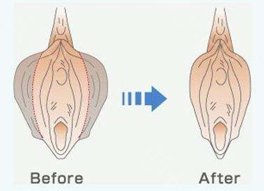 小阴唇手术