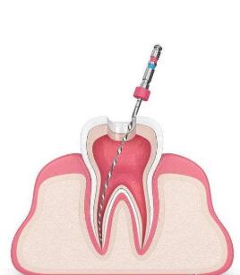 根管治疗