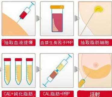 自体脂肪丰胸流程图
