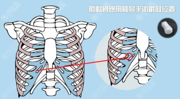 取肋软骨位置示意图