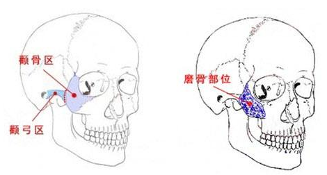 为什么做完颧骨缩小手术后悔死了