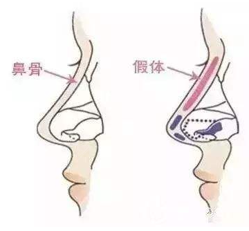 假体隆鼻出现排异怎么办呢？