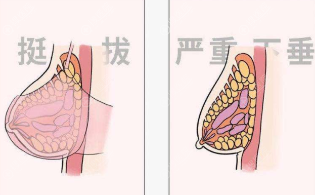 人工韧带乳房提升术效果怎么样？