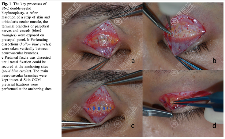 保留血管双眼皮手术原理
