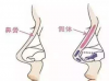 假体隆鼻出现排异现象，取出后还能再次做肋骨鼻吗？