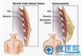 男性乳房太大怎么办 北京八大处整形告诉你这是病得治
