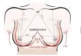 广州韩妃丰胸谁做的好？从内窥镜假体丰胸杨伟杰案例和价格来看