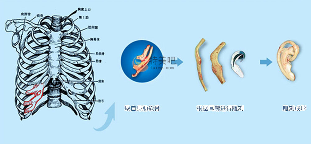 不扩张法外耳再造术