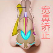 宽鼻矫正