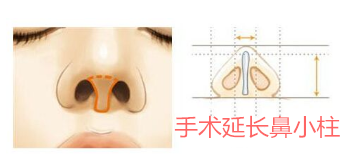 手术延长鼻小柱