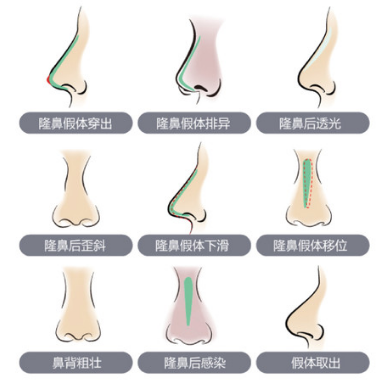 北京隆鼻修复有没有比较厉害的医生?北京鼻修复医生名单~